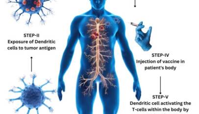dendritic cell therapy