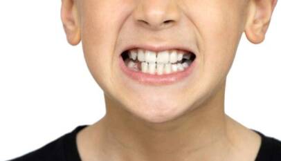 teeth whitening Bristol