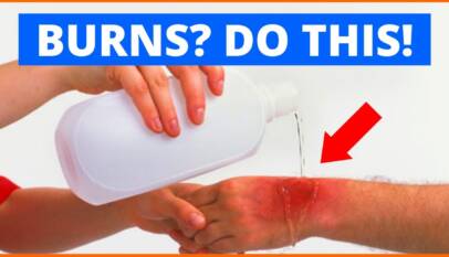 Doctor providing professional Burn Treatment at First Care Family Clinic.