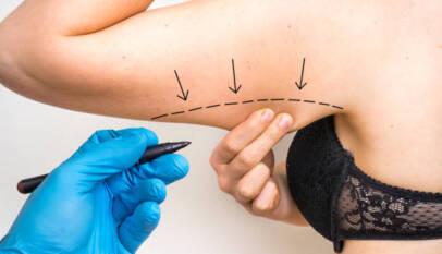 Liposuction surgery in Dubai