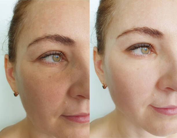 VI Peel Before and After