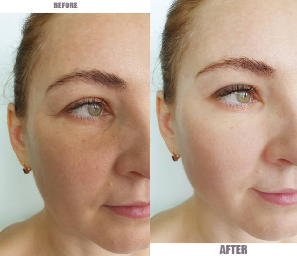 VI Peel Before and After